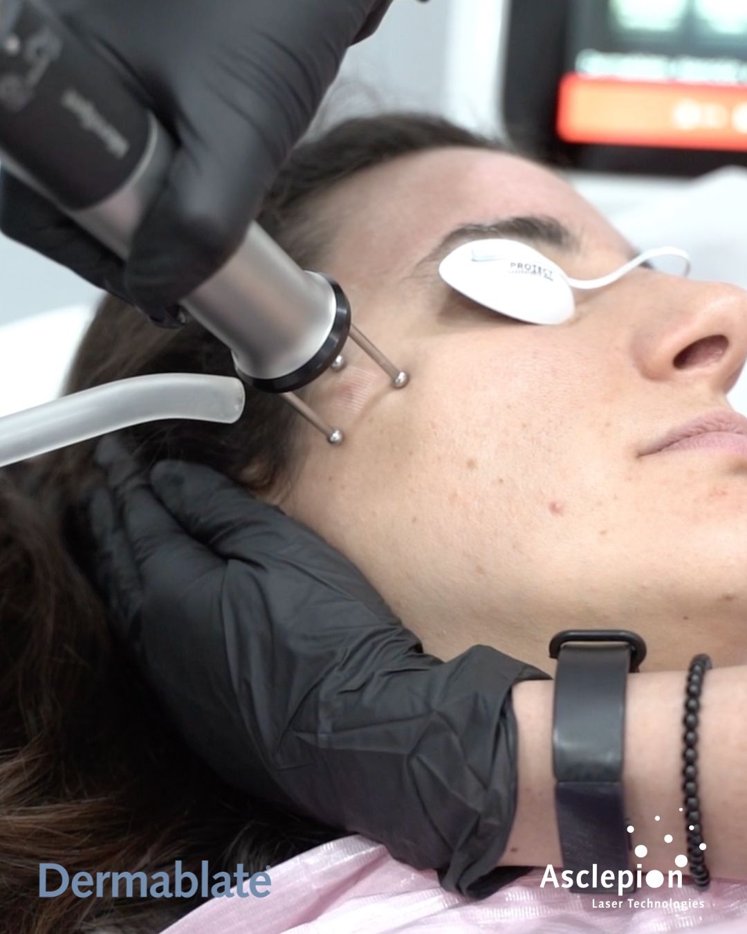 Pièce à main Dermablate® Variospot, laser Erbium YAG